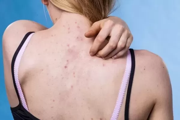 친구랑 화장품 같이 쓰지 마세요...하반신 마비된 여성 사례 올리며 위험성 경고한 의사