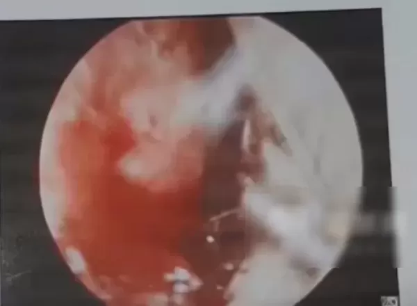 손가락으로 격하게 코 파다 동맥 파열돼 응급 수술받은 남성