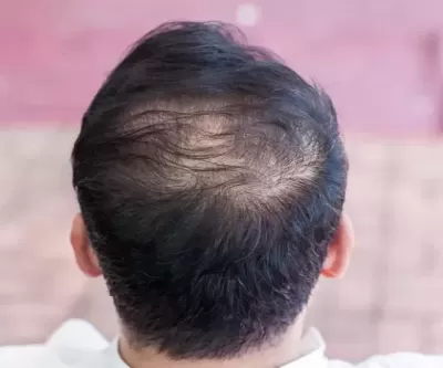 이것 자주 마시는 남성, 탈모 올 확률 3배 높다