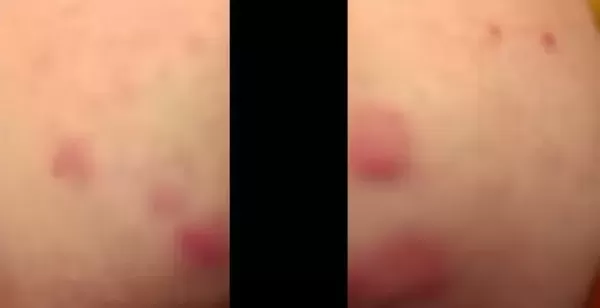 성관계 후 엉덩이 발진 생긴 30대 남성... 매독 아닌 새로운 성병 감염 위험