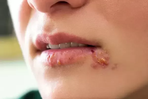 입술 보더니 너 성병이지? 몰아간 절친 손절했습니다