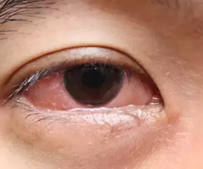 각막 90% 이상 회복하고 시력도 향상... 각막 손상 실명 치료하는 줄기세포 치료법 나왔다