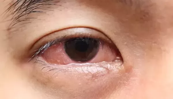 각막 90% 이상 회복하고 시력도 향상... 각막 손상 실명 치료하는 줄기세포 치료법 나왔다