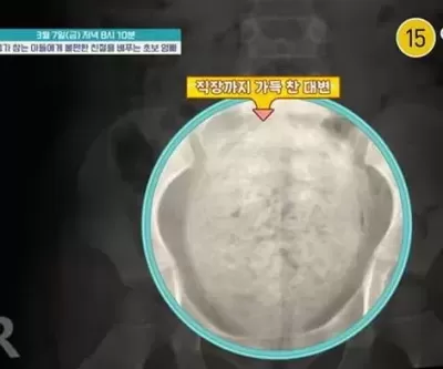 직장까지 단단한 변으로 꽉 차... 배변 거부하는 4세 금쪽이의 충격적인 건강 상태