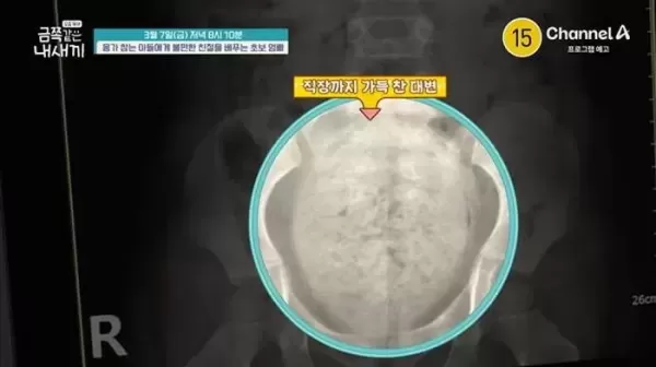 직장까지 단단한 변으로 꽉 차... 배변 거부하는 4세 금쪽이의 충격적인 건강 상태