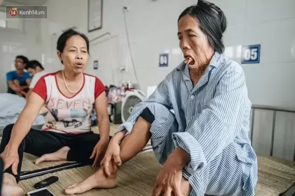 어릴 적 부엌 지키다 화상입고 48년간 괴물 취급 당한 여성... 재건 수술로 새 삶 선물한 의료진