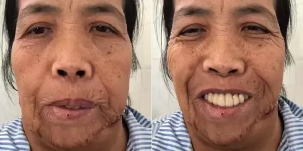 어릴 적 부엌 지키다 화상입고 48년간 괴물 취급 당한 여성... 재건 수술로 새 삶 선물한 의료진